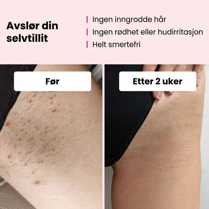Scandiva IPL - Profesjonell hårfjerning hjemmefra