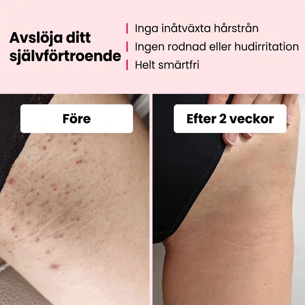 Scandiva IPL - Professionell hårborttagning hemifrån